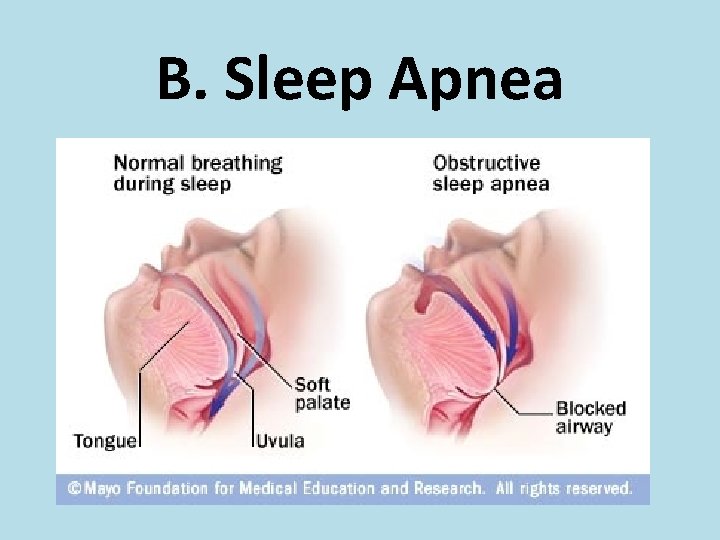 B. Sleep Apnea 