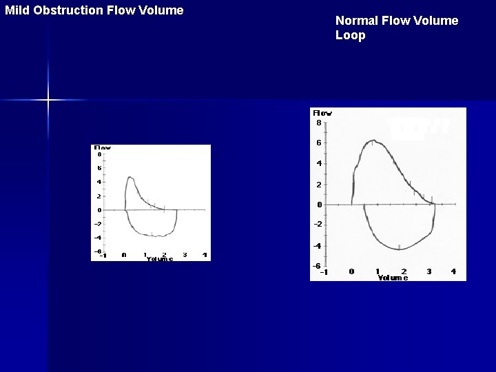 Mild Obstruction Flow Volume Normal Flow Volume Loop 