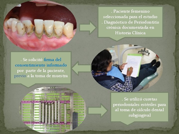 . Paciente femenino seleccionada para el estudio. Diagnóstico de Periodontitis crónica documentada en Historia