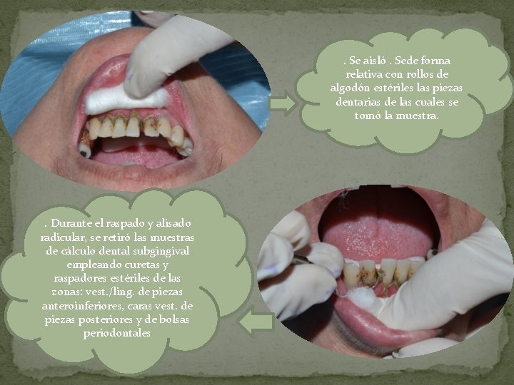 . Se aisló. Sede forma relativa con rollos de algodón estériles las piezas dentarias