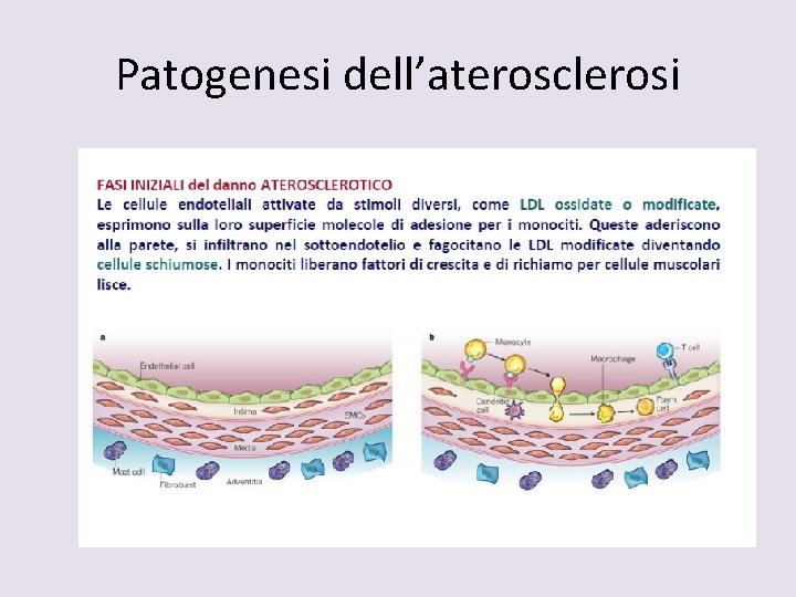 Patogenesi dell’aterosclerosi 