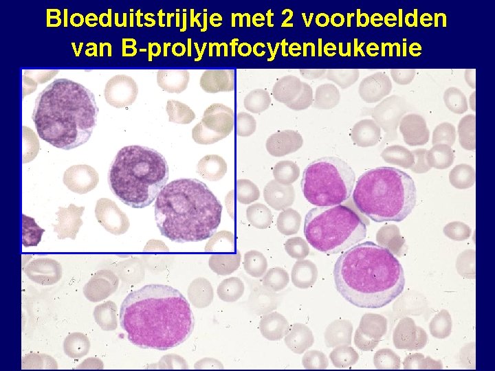 Bloeduitstrijkje met 2 voorbeelden van B-prolymfocytenleukemie 