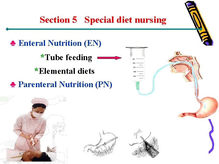 Section 5 Special diet nursing ♣ Enteral Nutrition (EN) *Tube feeding *Elemental diets ♣