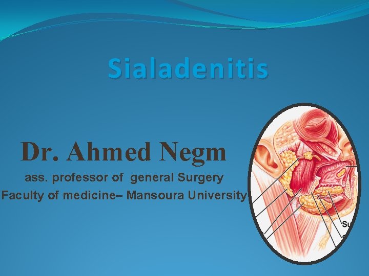 Sialadenitis Dr. Ahmed Negm ass. professor of general Surgery Faculty of medicine– Mansoura University