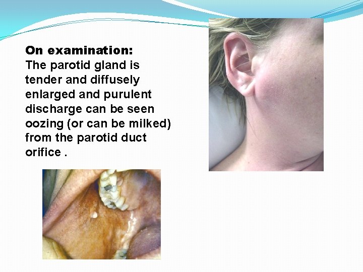 On examination: The parotid gland is tender and diffusely enlarged and purulent discharge can