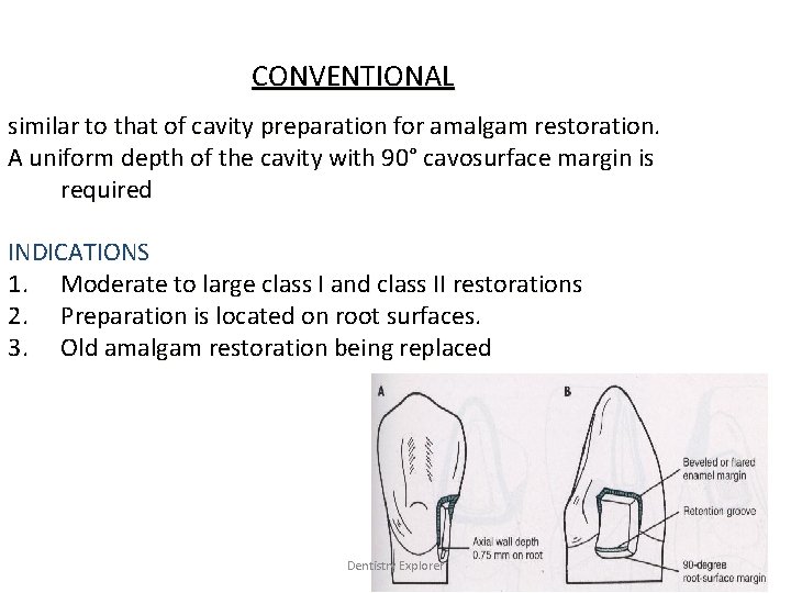 CONVENTIONAL similar to that of cavity preparation for amalgam restoration. A uniform depth of