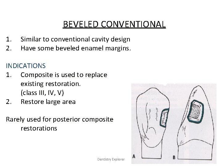 BEVELED CONVENTIONAL 1. 2. Similar to conventional cavity design Have some beveled enamel margins.