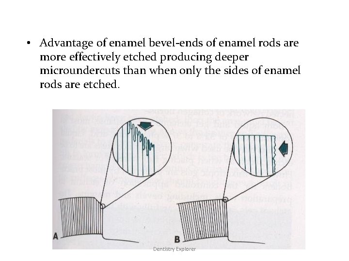  • Advantage of enamel bevel-ends of enamel rods are more effectively etched producing