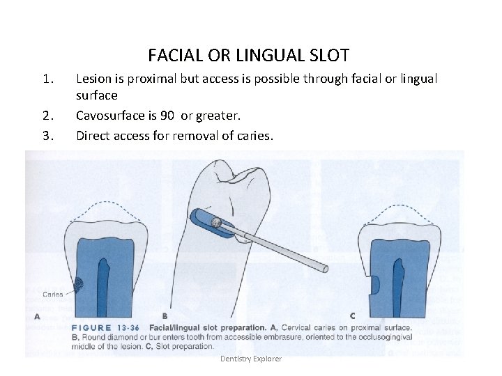 FACIAL OR LINGUAL SLOT 1. 2. 3. Lesion is proximal but access is possible