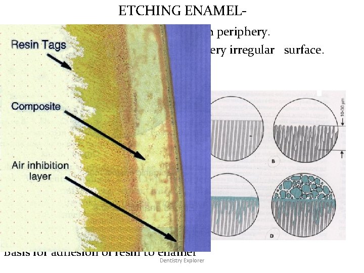 ETCHING ENAMEL- • affects both prism core and prism periphery. • transforms smooth enamel