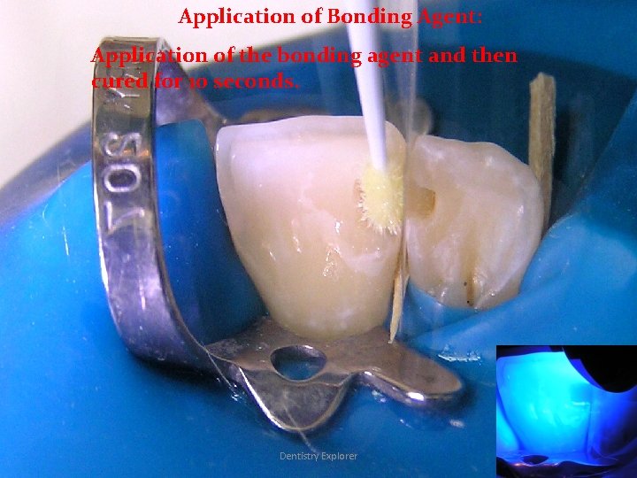 Application of Bonding Agent: Application of the bonding agent and then cured for 10