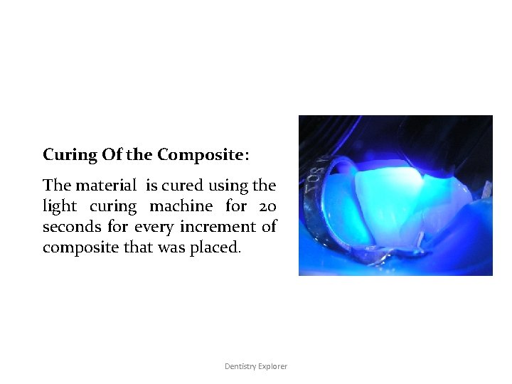 Curing Of the Composite: The material is cured using the light curing machine for