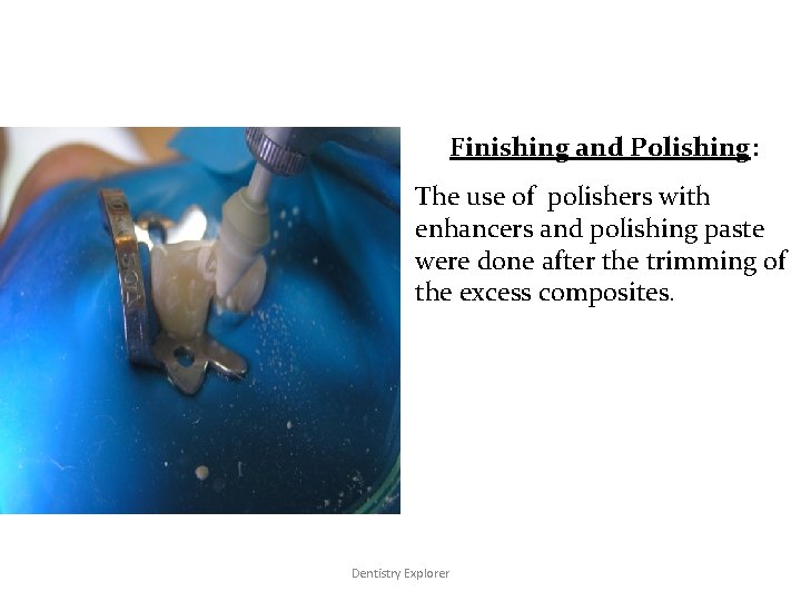Finishing and Polishing: The use of polishers with enhancers and polishing paste were done