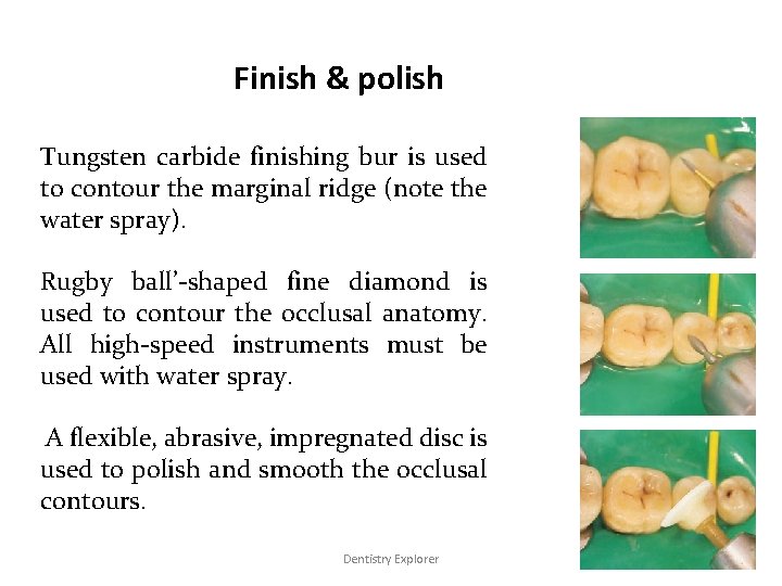 Finish & polish Tungsten carbide finishing bur is used to contour the marginal ridge