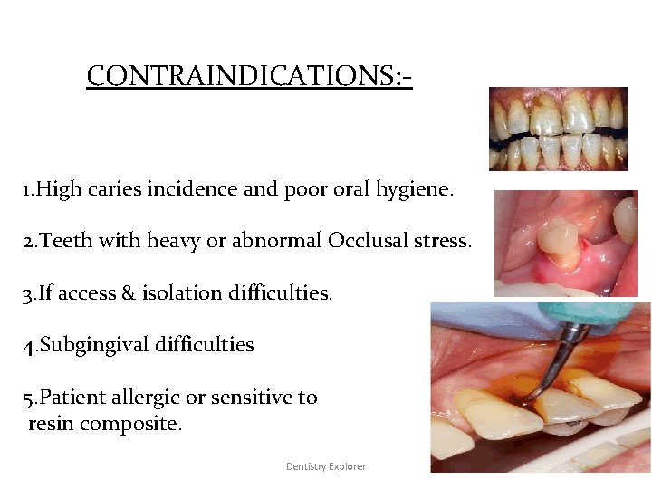 CONTRAINDICATIONS: - 1. High caries incidence and poor oral hygiene. 2. Teeth with heavy