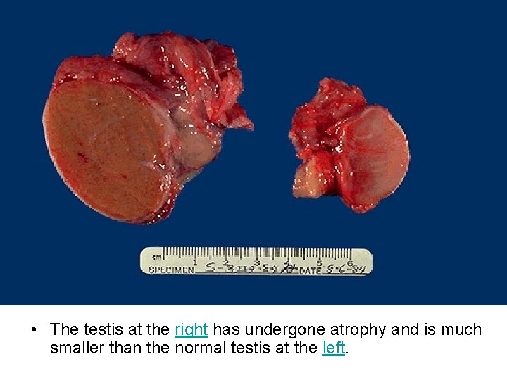  • The testis at the right has undergone atrophy and is much smaller