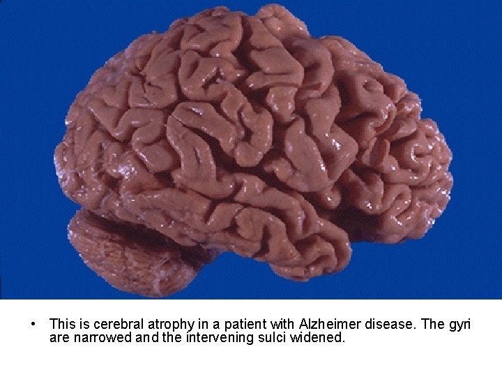  • This is cerebral atrophy in a patient with Alzheimer disease. The gyri