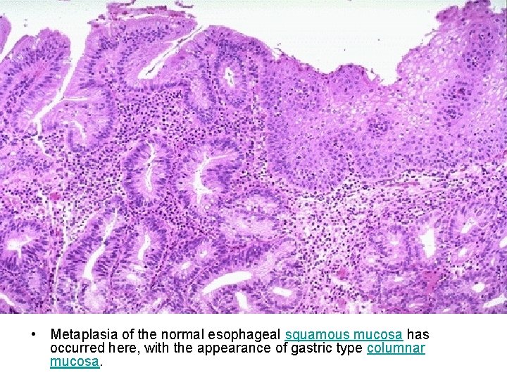  • Metaplasia of the normal esophageal squamous mucosa has occurred here, with the