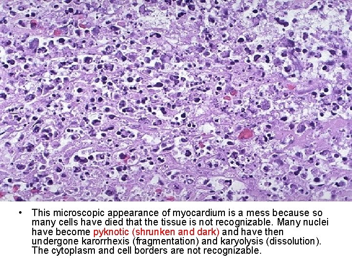  • This microscopic appearance of myocardium is a mess because so many cells