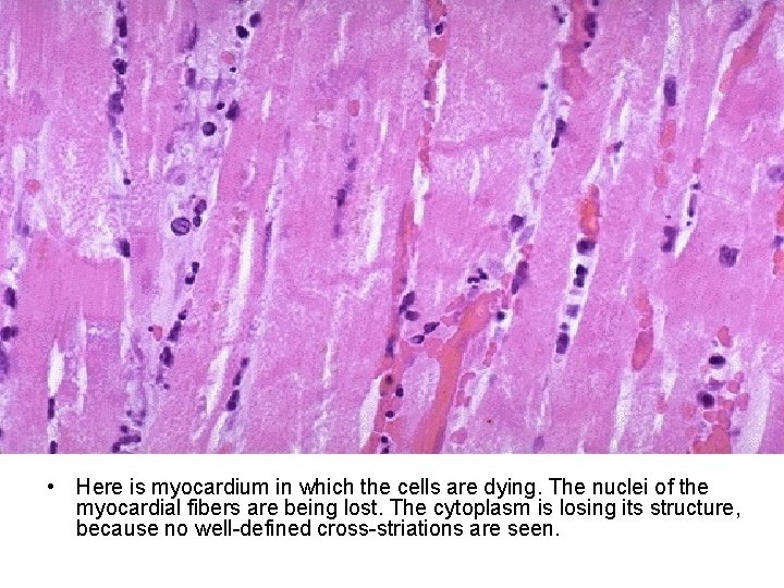  • Here is myocardium in which the cells are dying. The nuclei of