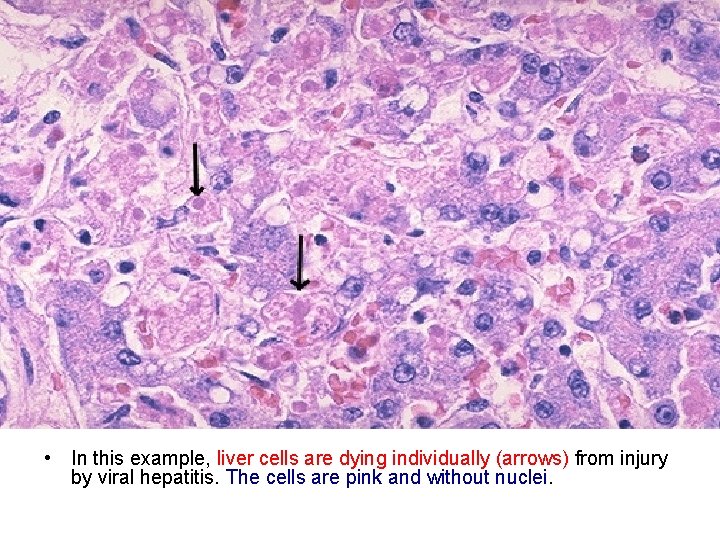  • In this example, liver cells are dying individually (arrows) from injury by