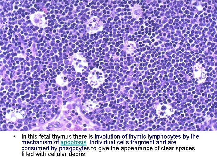  • In this fetal thymus there is involution of thymic lymphocytes by the