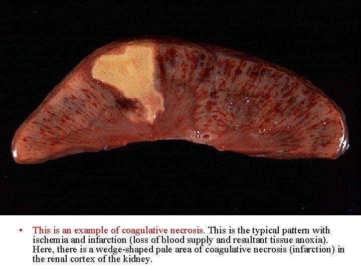  • This is an example of coagulative necrosis. This is the typical pattern