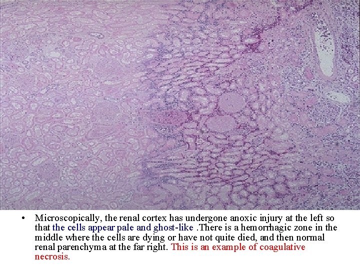  • Microscopically, the renal cortex has undergone anoxic injury at the left so