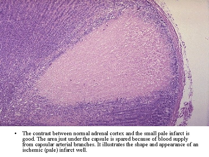  • The contrast between normal adrenal cortex and the small pale infarct is
