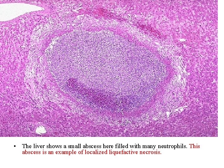  • The liver shows a small abscess here filled with many neutrophils. This