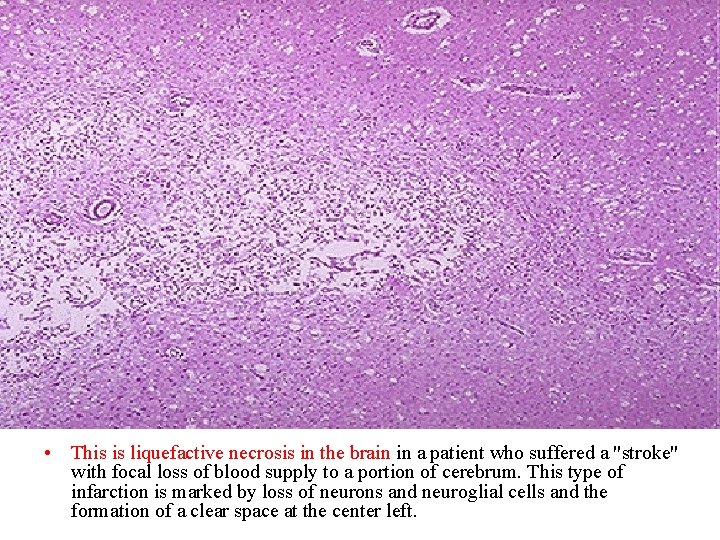  • This is liquefactive necrosis in the brain in a patient who suffered