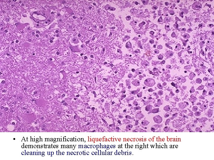  • At high magnification, liquefactive necrosis of the brain demonstrates many macrophages at