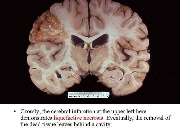  • Grossly, the cerebral infarction at the upper left here demonstrates liquefactive necrosis.