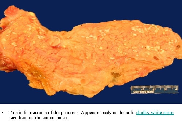  • This is fat necrosis of the pancreas. Appear grossly as the soft,