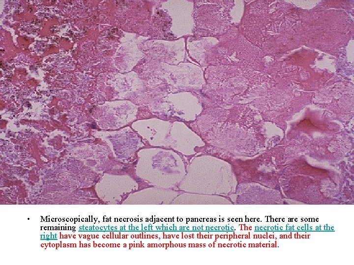  • Microscopically, fat necrosis adjacent to pancreas is seen here. There are some