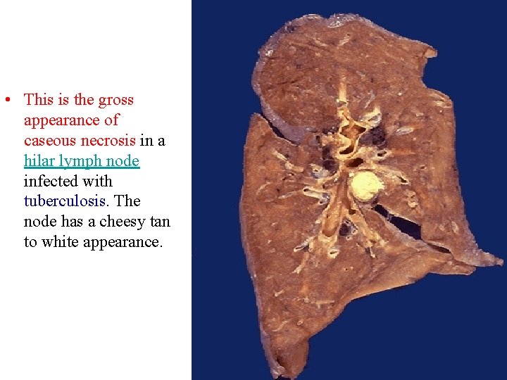  • This is the gross appearance of caseous necrosis in a hilar lymph