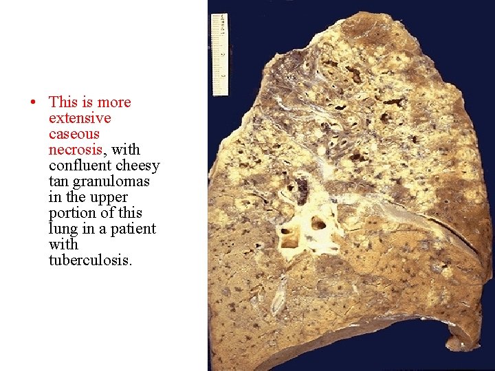  • This is more extensive caseous necrosis, with confluent cheesy tan granulomas in