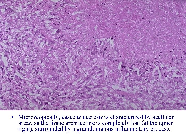  • Microscopically, caseous necrosis is characterized by acellular areas, as the tissue architecture