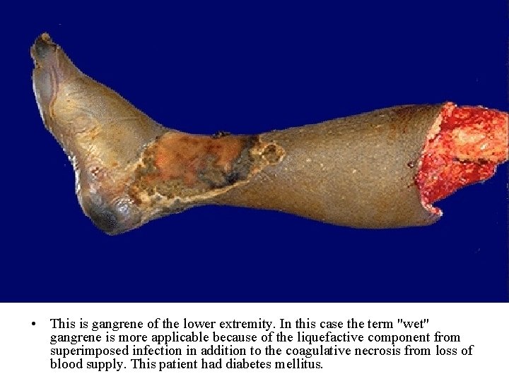  • This is gangrene of the lower extremity. In this case the term