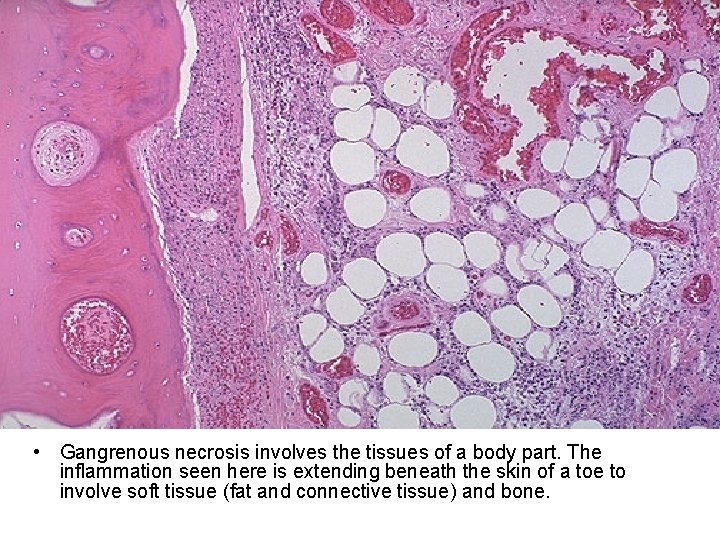  • Gangrenous necrosis involves the tissues of a body part. The inflammation seen