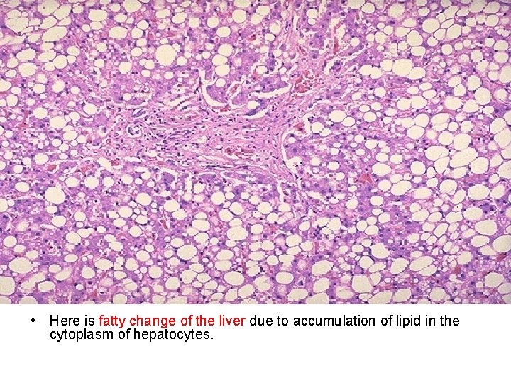  • Here is fatty change of the liver due to accumulation of lipid