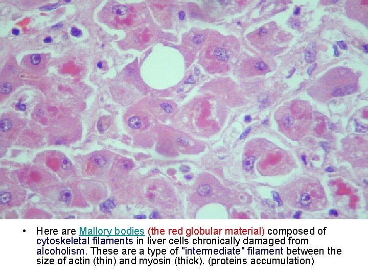  • Here are Mallory bodies (the red globular material) composed of cytoskeletal filaments