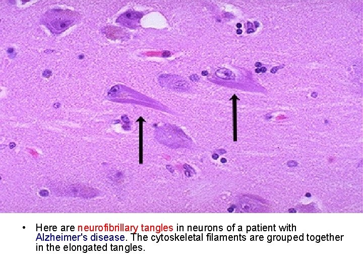  • Here are neurofibrillary tangles in neurons of a patient with Alzheimer's disease.