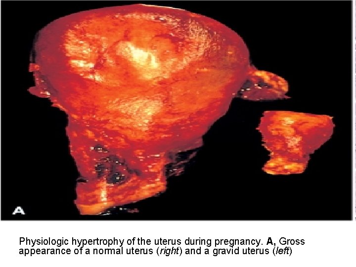 Physiologic hypertrophy of the uterus during pregnancy. A, Gross appearance of a normal uterus