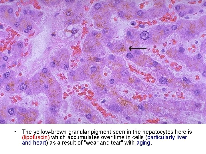  • The yellow-brown granular pigment seen in the hepatocytes here is (lipofuscin) which