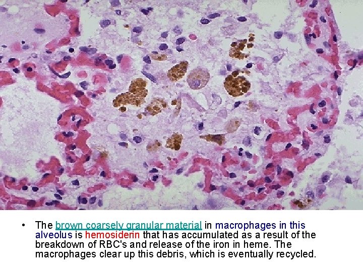  • The brown coarsely granular material in macrophages in this alveolus is hemosiderin