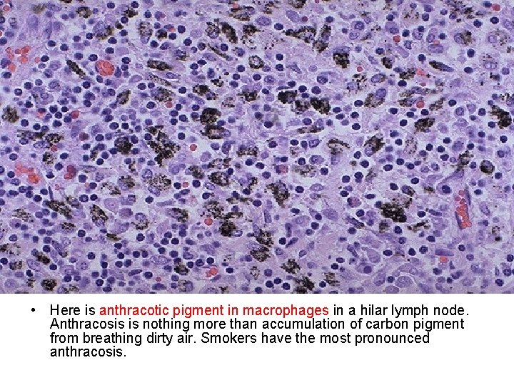  • Here is anthracotic pigment in macrophages in a hilar lymph node. Anthracosis