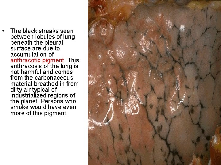  • The black streaks seen between lobules of lung beneath the pleural surface