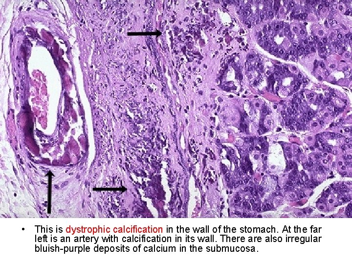  • This is dystrophic calcification in the wall of the stomach. At the