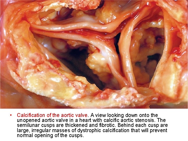  • Calcification of the aortic valve. A view looking down onto the unopened